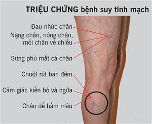 Bệnh giãn tĩnh mạch chân đang ngày càng trẻ hóa