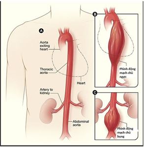 Điều trị các bệnh lý phình động mạch chủ bằng Stent Graft